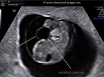 umbilical-cord-cysts