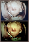 3D ultrasound image fetus in fetoscopic view