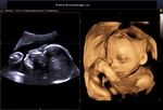 3D ultrasound fetus - fetoscopic view